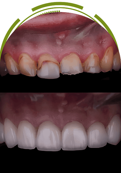 Smile makeover before and after – full upper dental restoration with crowns or veneers | EnamelDent Veneers Tijuana